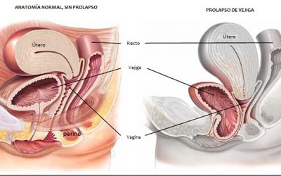 El efecto de la gimnasia hiporesiva en las pérdidas de orina